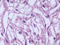 結腸脂肪瘤 結腸脂肪瘤