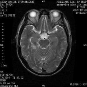 腦缺血灶 腦缺血灶