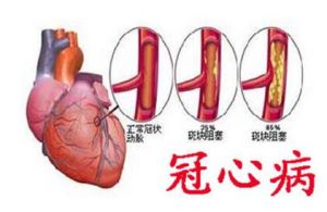 冠心病