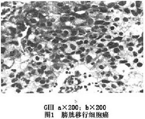 (圖)膀胱移行細胞癌