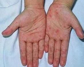 皮下出血點 皮下出血點