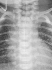 新生兒濕肺 新生兒濕肺