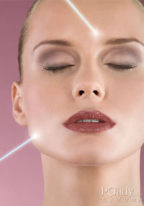 雷射除皺 雷射除皺