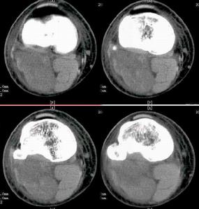 何杰金氏淋巴瘤