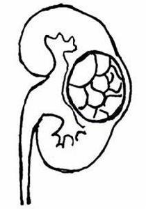 多房性腎囊腫 多房性腎囊腫