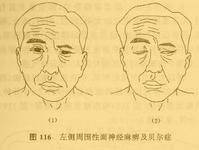 周圍面神經炎 周圍面神經炎