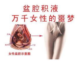 病理性盆腔積液 病理性盆腔積液