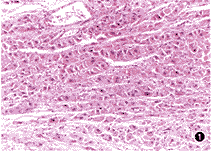 （圖）肝纖維板層癌