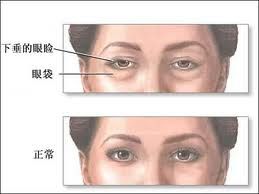 眼瞼整形術