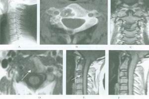 多骨纖維發育不良