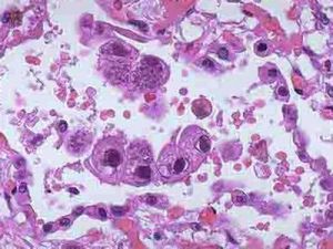 人腸道細胞病變孤兒病毒 人腸道細胞病變孤兒病毒