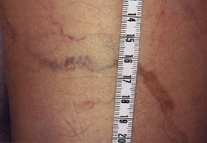 單純性下肢靜脈曲張