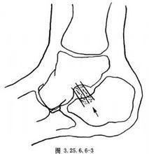 距下關節外融合術 距下關節外融合術