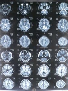 遺傳性共濟失調