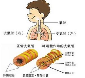 正常支氣管與哮喘病人的支氣管
