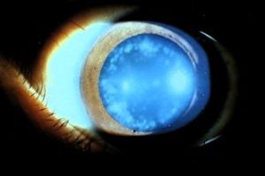 白內障--晶體混濁