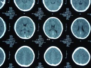 靜脈竇血栓 靜脈竇血栓