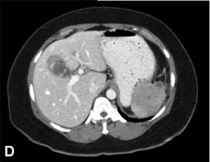 腹膜後膿腫 腹膜後膿腫