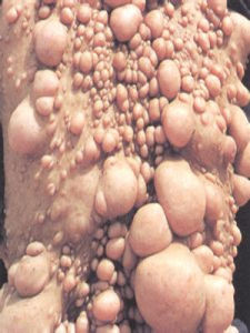 纖維瘤病 纖維瘤病