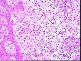 大細胞淋巴瘤 大細胞淋巴瘤