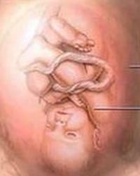 妊娠毒血症