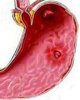 上消化道出血 上消化道出血