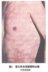 持久性色素異常性紅斑