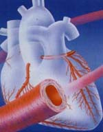 老年人急性心肌梗死