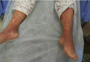 紅人綜合症 紅人綜合症