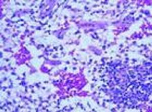 肺炎性假瘤 肺炎性假瘤