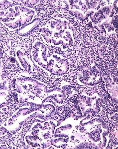 宮頸腺癌 宮頸腺癌