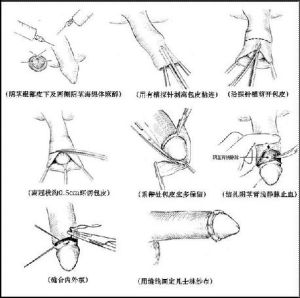 韓式包皮包莖整形美容術