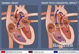 完全性大動脈轉位矯正手術