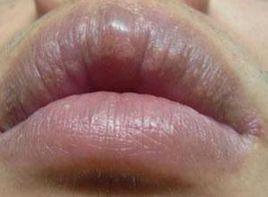 泛發性紅色斑塊 泛發性紅色斑塊