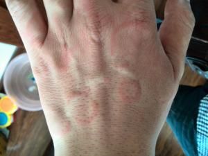 環狀紅斑 環狀紅斑