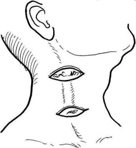 鰓裂瘺管 鰓裂瘺管