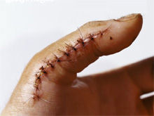 開放性手外傷 開放性手外傷