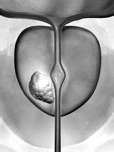 前列腺癌 前列腺癌