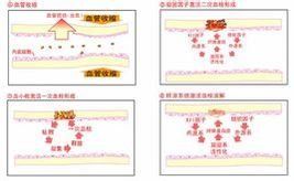低凝血酶原血症