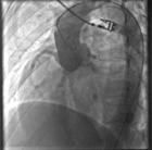 主動脈竇瘤破裂