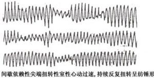 尖端扭轉型室性心動過速 尖端扭轉型室性心動過速