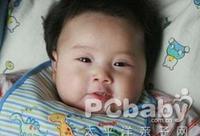 小兒碘缺乏病 小兒碘缺乏病