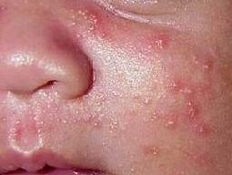 丘疹型痘痘