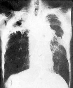 肺結核病灶 肺結核病灶