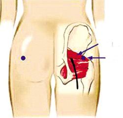 髂腹股溝神經乾痛 髂腹股溝神經乾痛