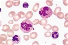 中性白細胞浸潤圖片