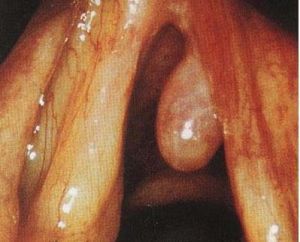 喉嚨息肉 喉嚨息肉