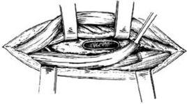 帶蒂肌瓣填充術 帶蒂肌瓣填充術