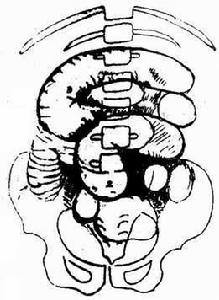 單純性小腸梗阻 單純性小腸梗阻