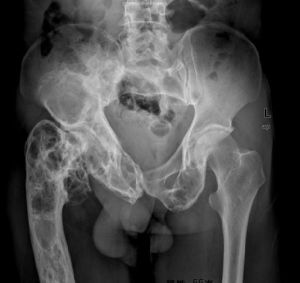 骨纖維異常增殖症